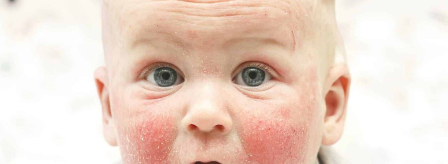 atopowe zapalenie skóry u dzieci przyczyny objawy leczenie