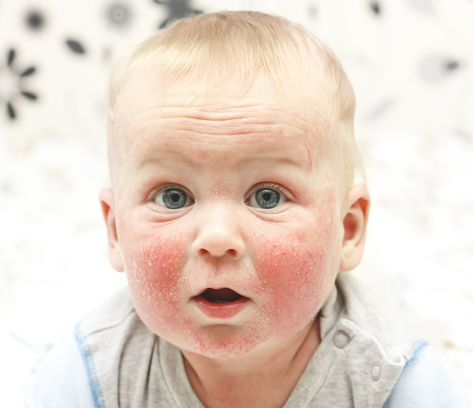atopowe zapalenie skóry u dzieci przyczyny objawy leczenie