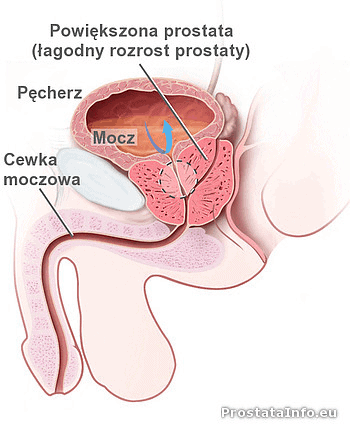 jak zmniejszyć przerost prostaty)