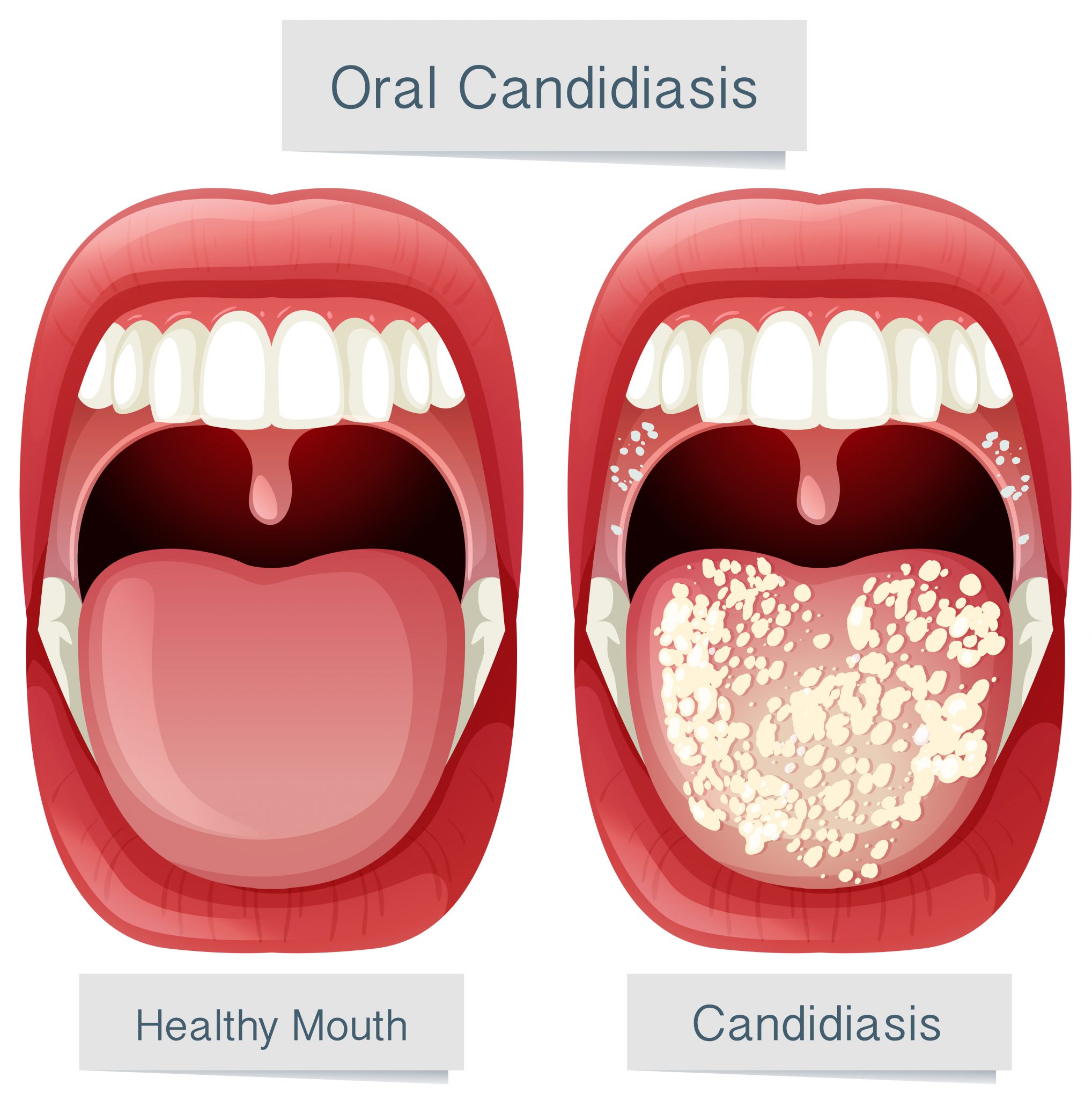 Kandydoza Jamy Ustnej Objawy Przyczyny I Sposoby Leczenia Medovitapl 4362